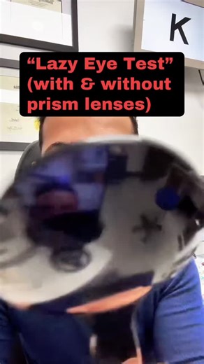 Vivid Visions Optometry, Inc on Instagram: "Dr. Antonyan, O.D. performs the self cover test with and without prism lenses to spread awareness of Binocular Vision Dysfunction (BVD). This test doesn’t check for a lazy eye; it tests for phoria: a hidden eye misalignment that can cause headaches, dizziness, eye strain, and anxiety. Watch how the eyes shift when one is covered and uncovered. Located in Valencia, CA. Virtual therapy and consultations available. www.vividvisionsoptometry.com/appointmen