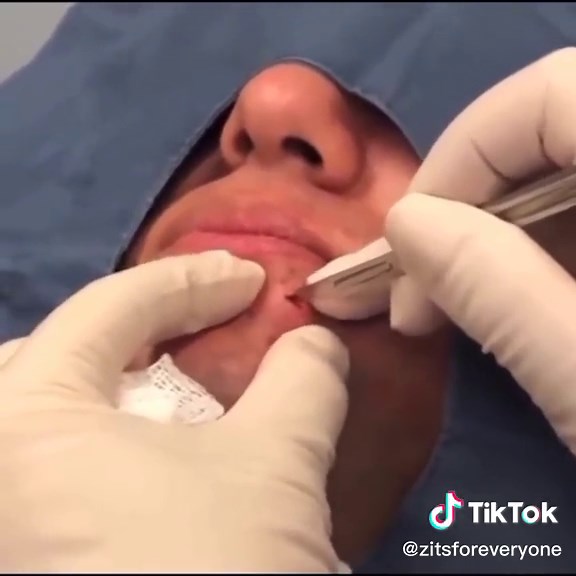 #pimplepopper #pimplepopping #zits