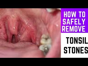 What are tonsil stones and how to remove them safely