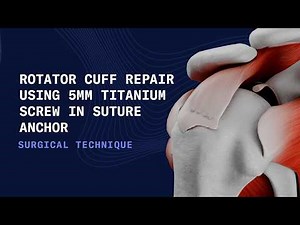 Rotator Cuff Repair: Medial Row Fixation with Titanium Suture Anchors