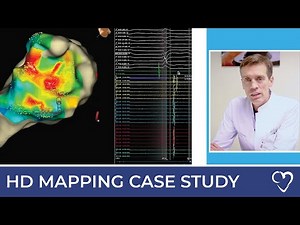 Case Study: Catheter Ablation of Ventricular Tachycardia with HD Mapping