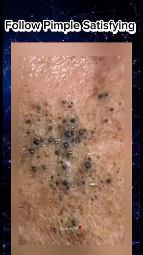 ✨Big Pimple blackhead removal #pimple #popping #acne #blackhead #satisfying #extractions #pimpleremover