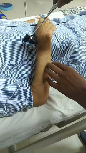 Exaggerated biceps and supinator reflex