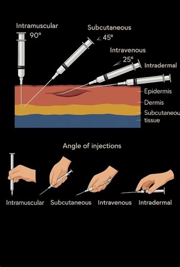 mindsoul on Instagram: "Not All Shots Are Created Equal – Your Quick Guide to Injection Types Ever wondered why some shots go in your arm muscle and others just under the skin? Here’s the breakdown: Intramuscular (IM) → Deep into the muscle (vaccines, hormones) Subcutaneous (SC) → Into the fatty layer (insulin, blood thinners) Intravenous (IV) → Straight into the vein (instant effect) Intradermal (ID) → Just under the skin surface (TB tests, allergy testing) Intraosseous (IO) → Into bone marrow 