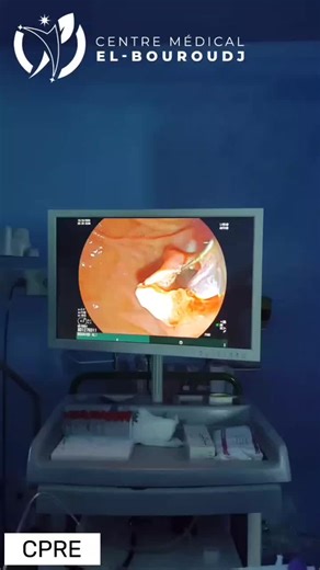 Cholangio-Pancreatography Rétrograde Endoscopique: Exploration et Traitement des Voies Biliaires