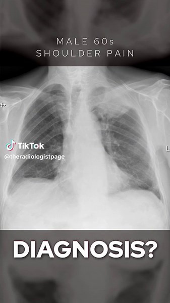 Understanding Shoulder Pain: What Does the X-Ray Reveal?