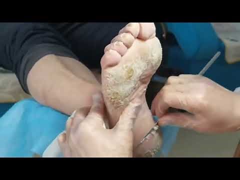 Cracked Heels. So satisfying, 9 mins Dead skin removal and Cracked heel treatment.
