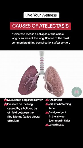 Understanding Atelectasis: Causes and Treatment Options