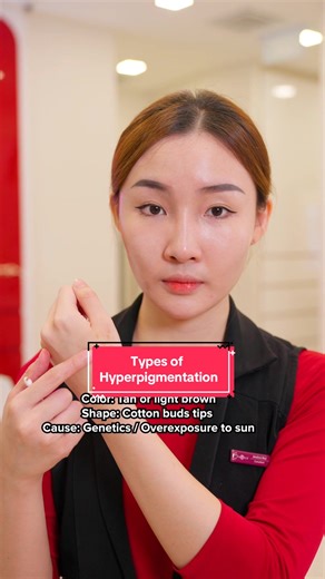 Freckles, age spots, post-acne pigmentation – Shakura is your skincare solution 💖✨ #Shakura #MirokoWhiteningTreatment #skinpigmentation #darkspots #skincareadvice #skincaretips #skingoals #goodbyepigmentation #sgfacials #hyperpigmentation