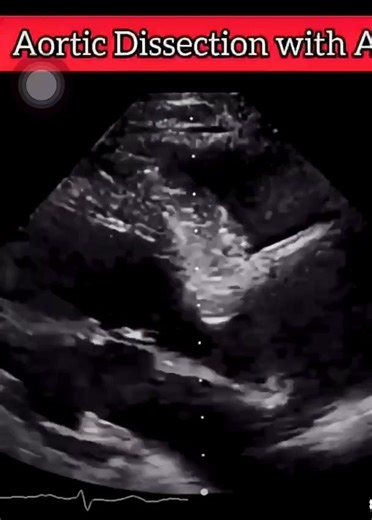 اوعى تنسى المكان ده ف الايكو.. ممكن type B dissection والعيان معندوش اعراض خالص ويبقى بداية التشخيص من اول بصة ف الايكو This flab in descending aorta in parasternal long axis view.. | Hisham Alshamekh