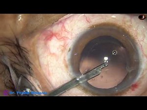 A real-time routine cataract surgery under Topical anesthesia : 24th Nov, 2021