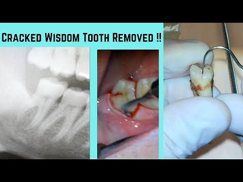 Wisdom tooth extraction