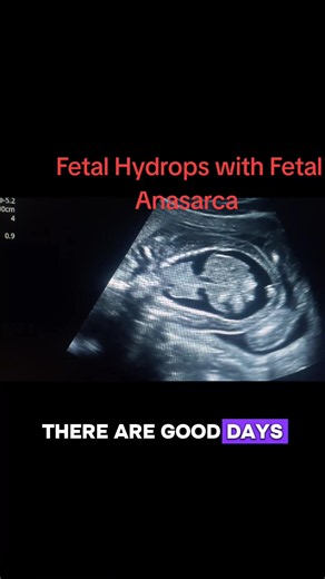 Hydrops fetalis is a rare, life-threatening condition in which excessive fluid builds up in at least two different compartments of a fetus or newborn's body, leading to severe swelling (edema). It is not a disease itself, but rather a severe symptom of an underlying medical condition #ultrasound #fetalabnormalities #hydropsfetalis