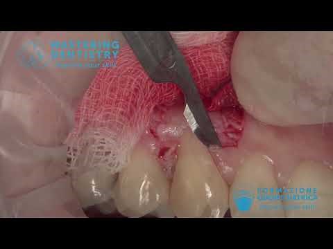 Coronally advanced flap