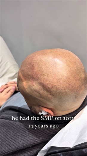 SMP touch-up: the detail work that keeps results sharp, natural, and long-lasting. Maintenance isn’t optional. It’s part of the process. ✔ restores density ✔ corrects fading ✔ keeps the hairline natural This is how SMP stays elite.#scalpmicropigmentation #smpuk #hairlosstreatment #buzzcut #hair