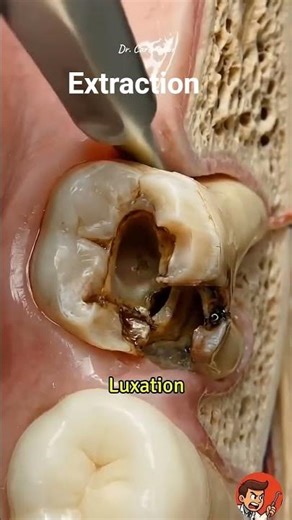 Extraction badly decayed tooth