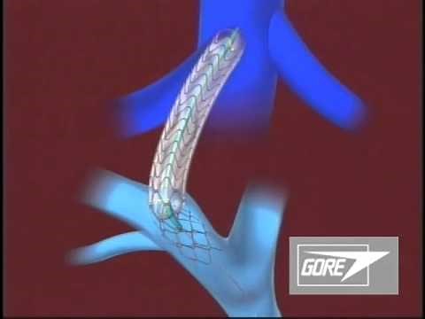 Endoprótese TIPS GORE® VIATORR®