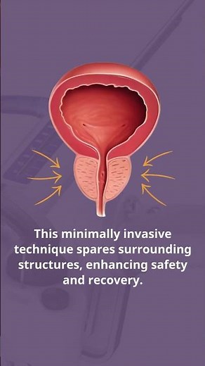 ⭐Aquablation Therapy! ⭐