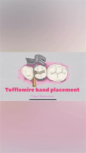 DR.DENTIQUE🦷 on Instagram: "Components of a Tofflemire Retainer (VERY IMPORTANT) 1. Head (U-shaped) • Holds the matrix band and allows band orientation. 2. Vise (Diagonal slot vise) • Holds the ends of the band securely. 3. Spindle (Long screw) • Tightens or loosens the band. 4. Set screw (Locking nut) • Locks the band in place. 5. Guide channels • Direct the band in the correct position (gingival/occlusal)."