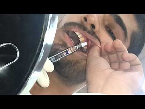 self infraorbital nerve block