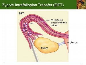 Zygote intrafallopian transfer as a type of assisted reproductive technology