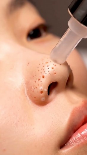 Spa-Level ASMR Blackhead Removal — Relaxing Suction Sounds