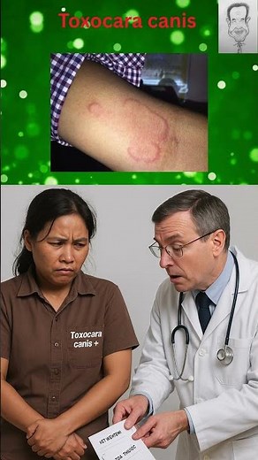 Nhiễm sán chó mèo (Toxocara canis): Tiêu chuẩn chẩn đoán và điều trị.