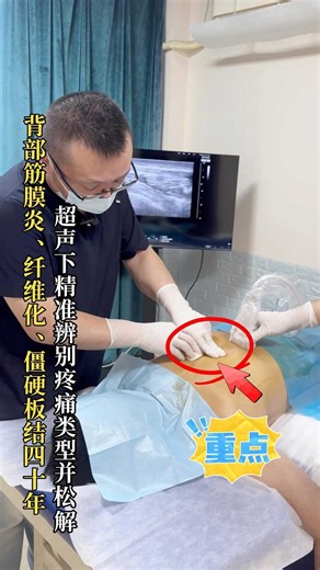 背部筋膜炎，筋膜纤维化僵硬板结四十年，超声下精准治疗