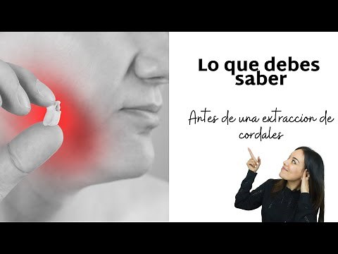 9 tips para la extraction de cordales - lo que tienes que saber antes de esta cirugía.