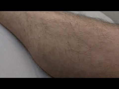 Right leg muscle fasciculations - Video 2