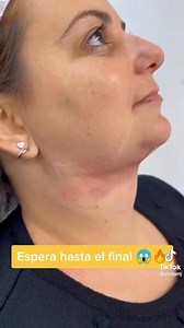 914 reactions · 22 comments | 朗CHIN LIPO朗 Awesome results only in my hands #drvictorverdugo ✨‍⚕️ Book now! | DR Victor Verdugo | Facebook