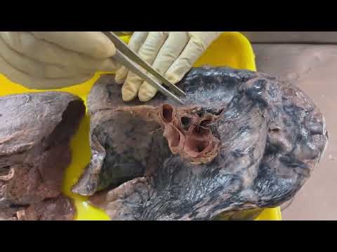 Lung Anatomy & Hilar Relations Simplified | Gross Anatomy Demo | Dr. Subhankar Roy