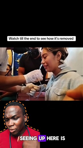 This is an ng tube insertion and removal #health #medicine #doctorr #ngtube #doctors