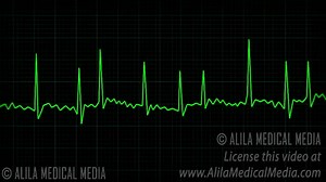 Atrial Fibrillation Anatomy, ECG and Stroke, Animation. on Make a GIF