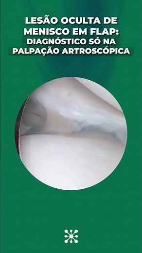 Menisco flap: sem palpação, sem diagnóstico #ortopediaavançada #artroscopia #menisco