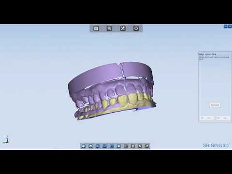 Shining 3D Dental scanner scan and Exocad design Single Anatomic Crown