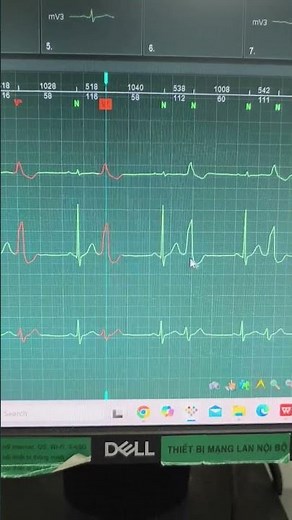 ECG Ngoại Tâm Thu Thất: Hướng dẫn đọc điện tim hay điện tâm đồ (ECG) Ngoại Tâm Thu Thất bởi Dr Chu