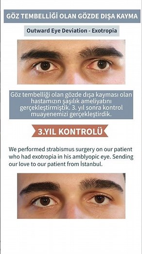 Göz tembelliği olan gözde dışa kayma ameliyatı / Exotropia surgery - Lazy eye
