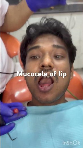 🩺 Mucocele of lip! Precision in Every Procedure ✨