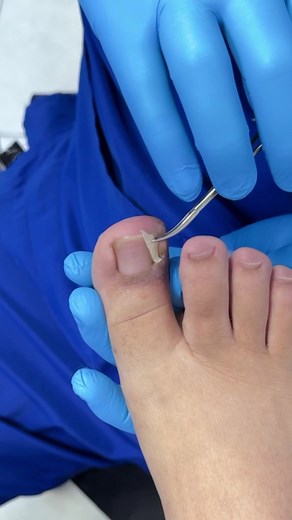 Cómo prevenir uñas encarnadas: Soluciones efectivas