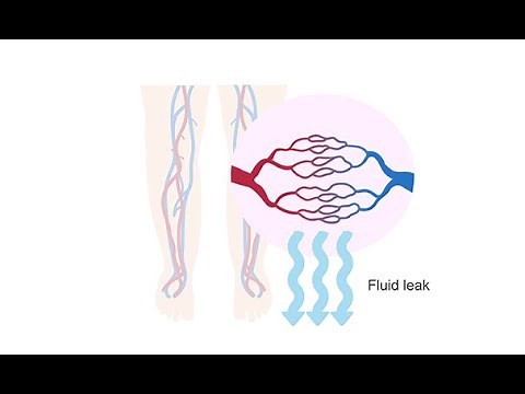 Generating a differential diagnosis for edema