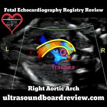 Right Aortic Arch Fetal Echocardiography