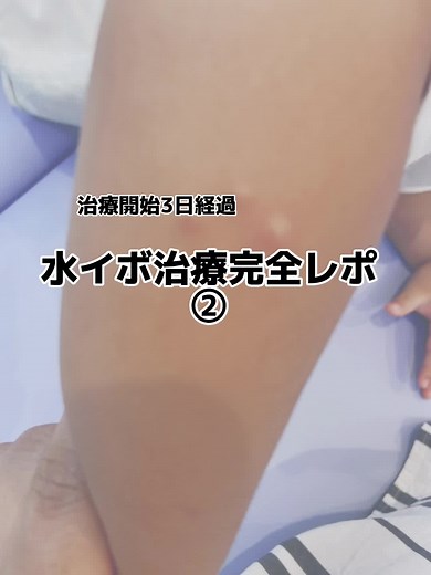 水イボ治療経過レポ
