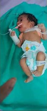 clavicle bone fracture in newborn and figure of 8 bandage treatment.