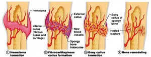 What are the stages of bone healing in order? [2025] | QAQooking.wiki