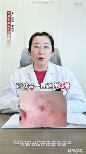 Doctors teach you step by step to deal with red swollen and large pimples without leaving
