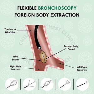 Flexible Bronchoscopy for Foreign Body Extraction - Dr. Ankit Parakh – India's best Pediatric Pulmonologist | Chest Specialist