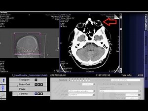 CT scan of brain+Orbit with contrast techniq