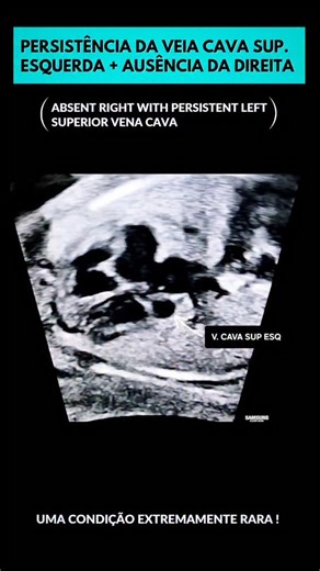Dr Alexandre M de Oliveira on Instagram: "A persistência da veia cava superior esquerda é uma das anomalias venosas torácicas mais comuns. Em alguns casos, pode estar associada também à ausência da veia cava superior direita, uma condição extremamente rara e de difícil diagnóstico no pré-natal. Os principais achados ecocardiográficos são: Seio coronário amplamente dilatado, 3VT anormal (3 vasos, porém com a VCSE à esquerda do canal arterial e VCSD ausente), fluxo reverso na veia braquiocefálica 