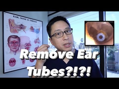Ear Tube Removal: when and why do we take ear tubes out, what is the aftercare